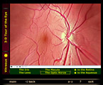 the vitreous body of the eye with the macula fovea retina and optic nerve screenshot